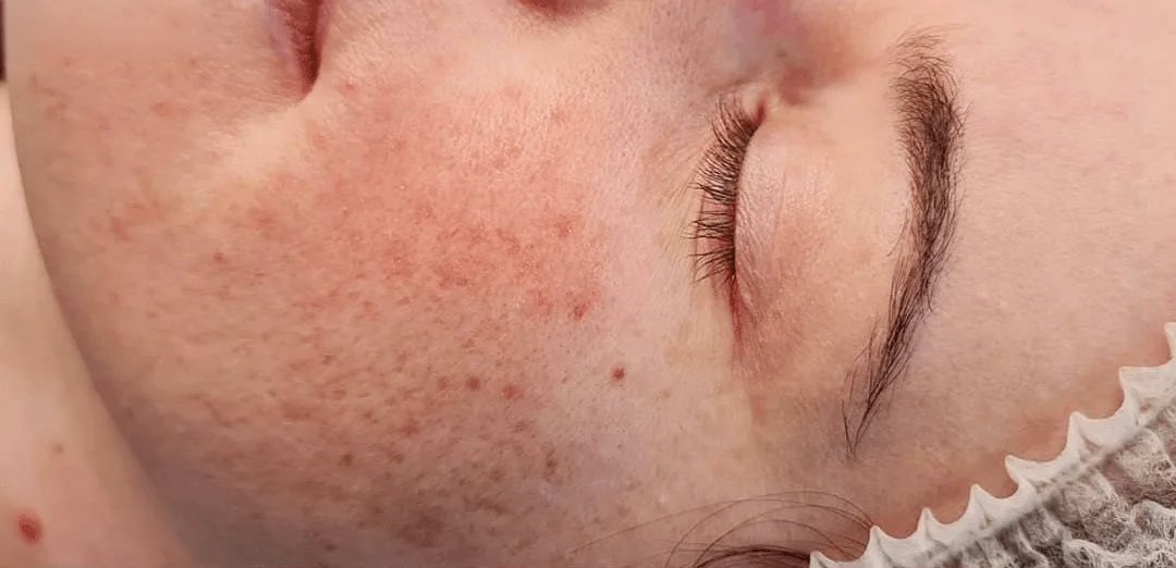 SSkin-BeforeAfter1_02