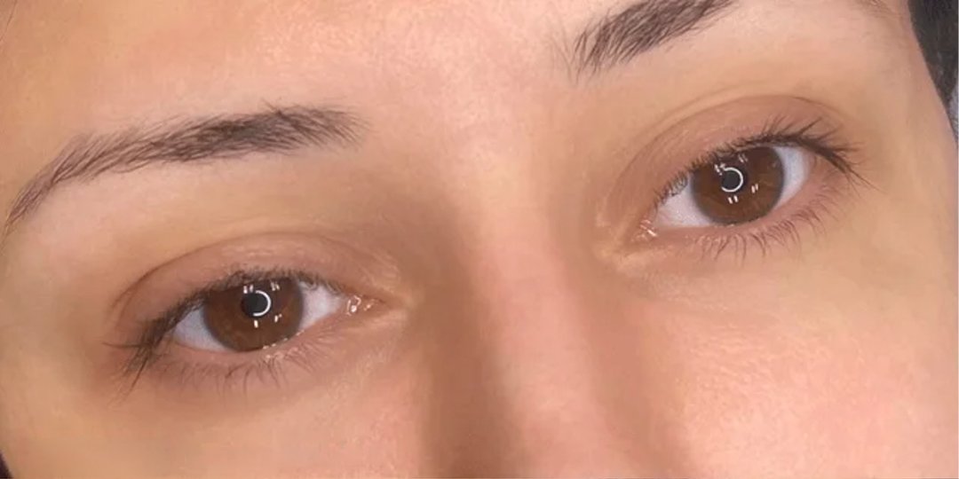 SSkin-BeforeAfter2_02